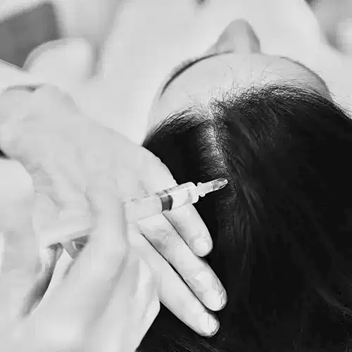 Tratamiento en Spa Belgrano: Mesoterapia Capilar